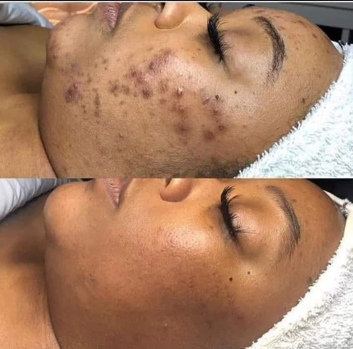 Gel d'Aloe Vera Anti-Acné et les points noirs