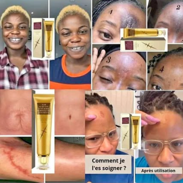 Crème Anti Cicatrice & Vergetures