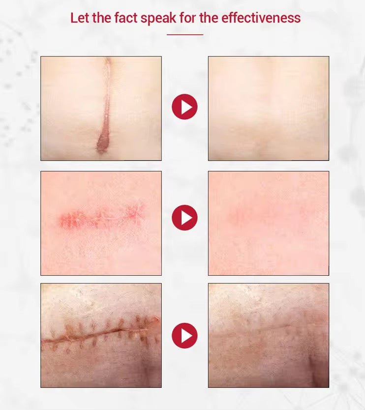 Crème Anti Cicatrice & Vergetures